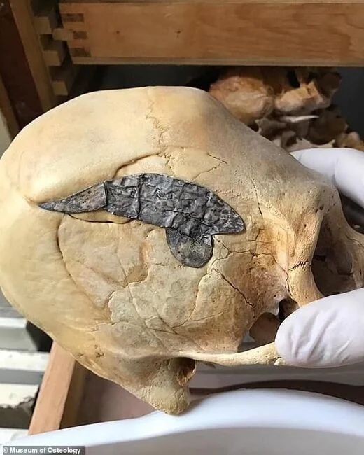 Удивительная находка: череп перуанского воина с металлической пластиной!🤯